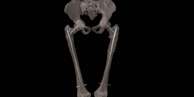 Full Femur Osteotomy