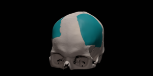 Skull reconstruction with patient specific implant