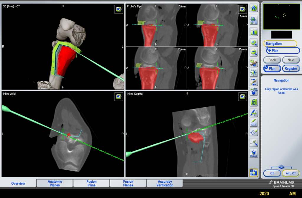 Reconstructie met donorbot - 3D-Lab+ 3DLab-LUMC